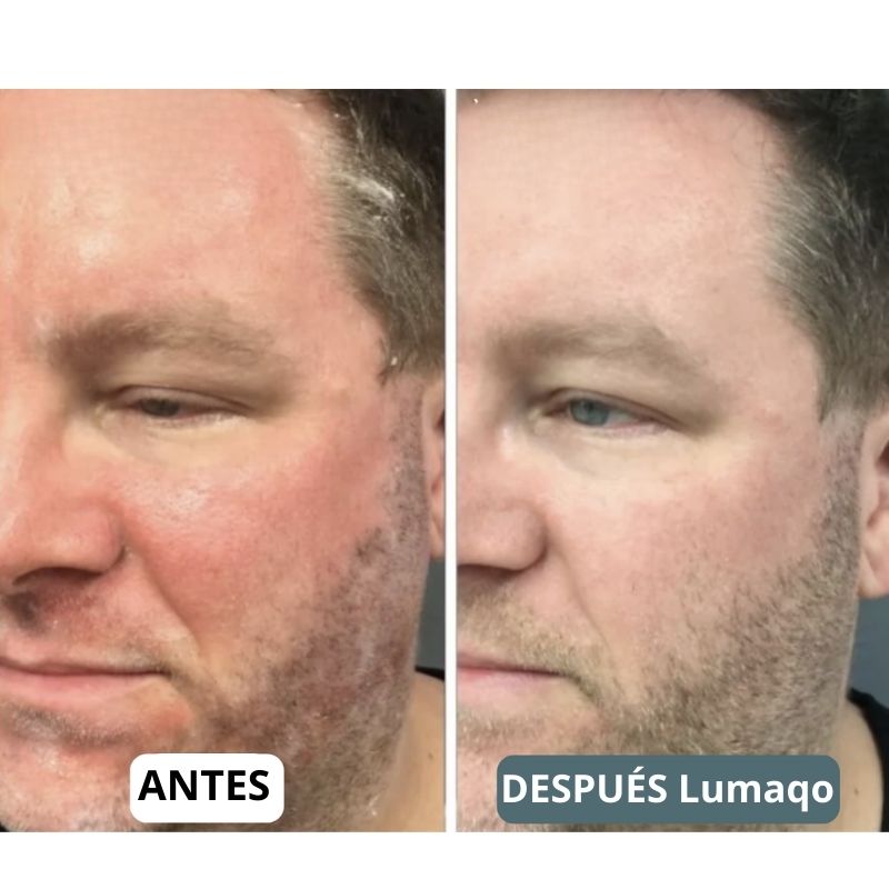 SensiCalma® Duo+ ⎜ Barba y cuero cabelludo calmados
